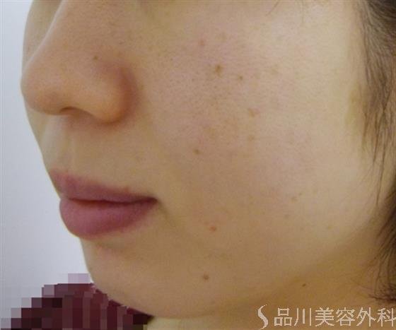 症例NO.27816のAFTER写真