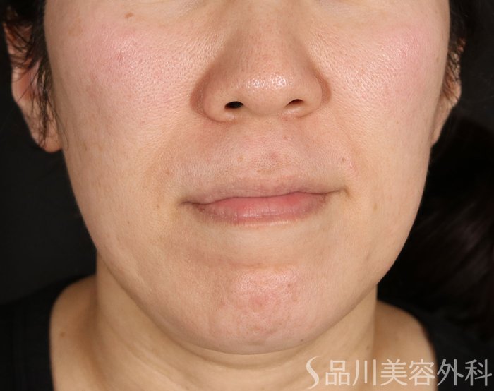 症例NO.72703のBEFORE写真