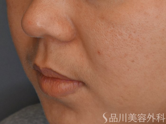 症例NO.70994のBEFORE写真