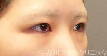 症例NO.65680のBEFORE写真