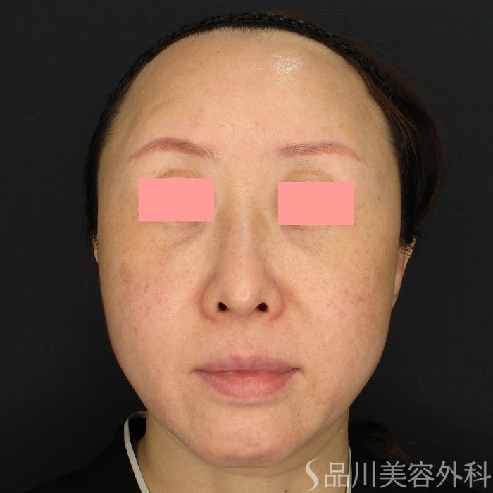 症例NO.71402のBEFORE写真