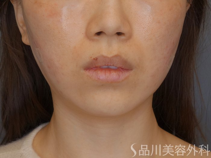 症例NO.72791のAFTER写真