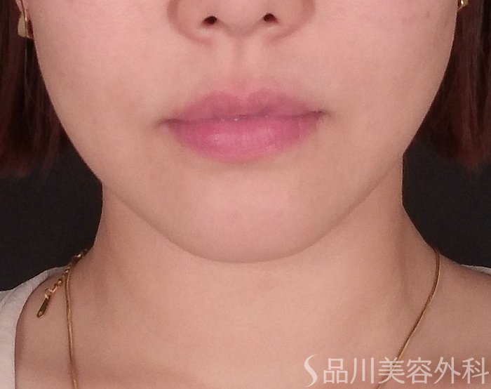 症例NO.69713のBEFORE写真