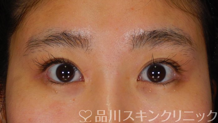 症例NO.63709のBEFORE写真