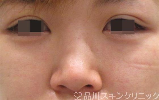 症例NO.26181のBEFORE写真