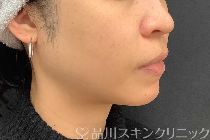 症例NO.69519のAFTER写真