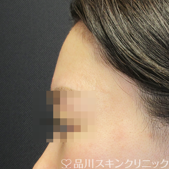 症例NO.69995のBEFORE写真