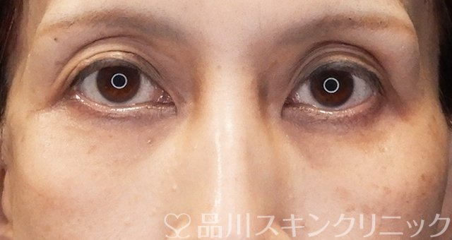 症例NO.67975のBEFORE写真