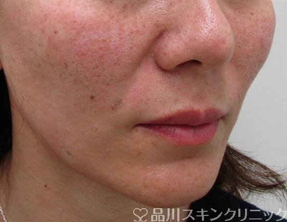 症例NO.34060のAFTER写真
