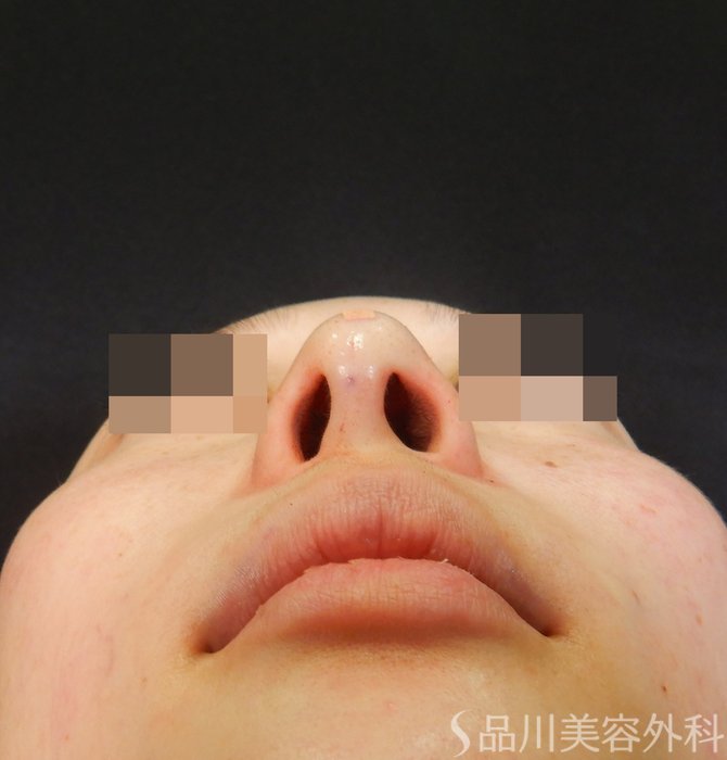 症例NO.65087のAFTER写真