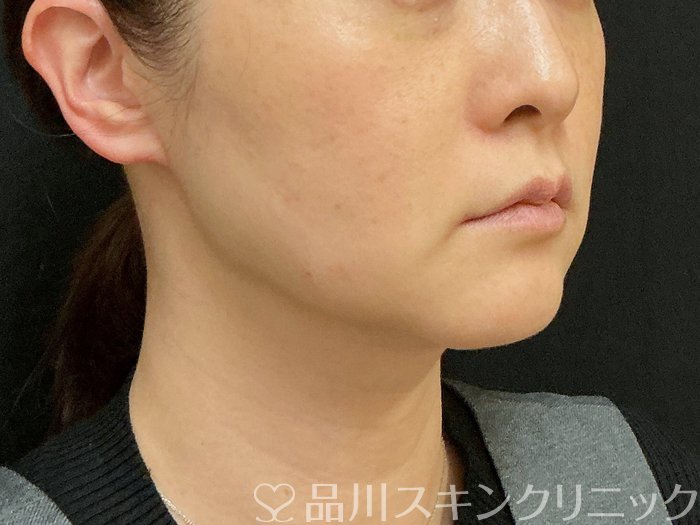 症例NO.74300のBEFORE写真