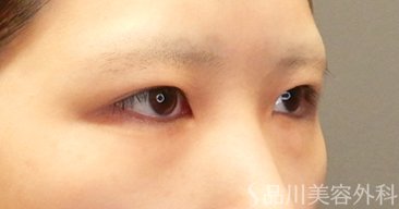 症例NO.65680のBEFORE写真