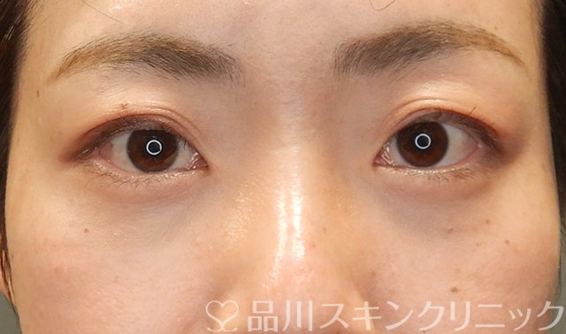 症例NO.68333のAFTER写真