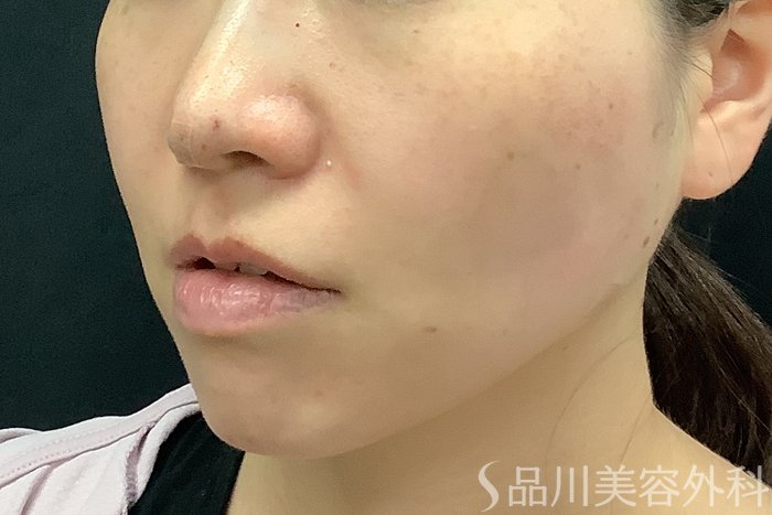 症例NO.71250のAFTER写真