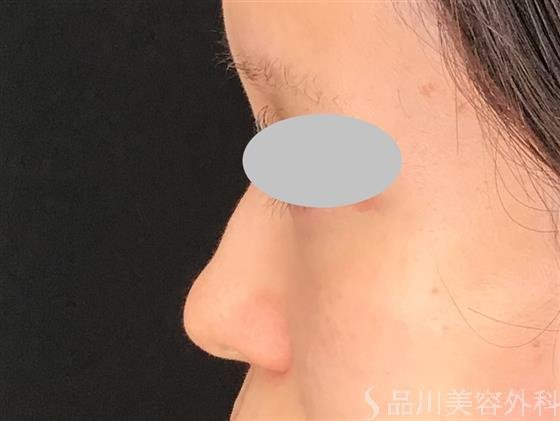症例NO.61219のBEFORE写真