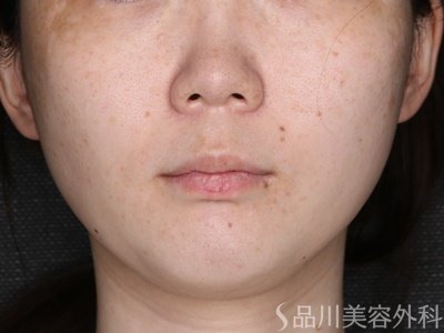 症例NO.74443のBEFORE写真