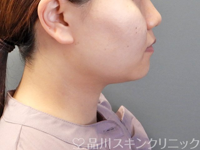 症例NO.63334のBEFORE写真