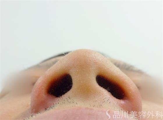 症例NO.23230のAFTER写真
