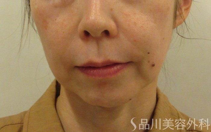 症例NO.71711のBEFORE写真