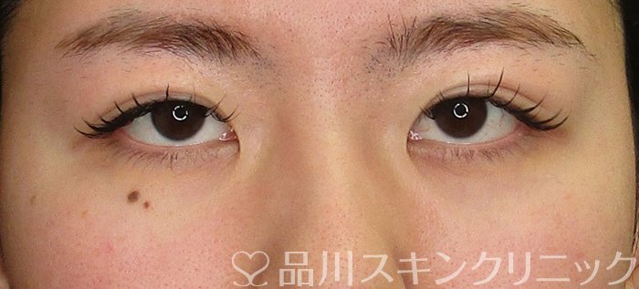 症例NO.69755のAFTER写真