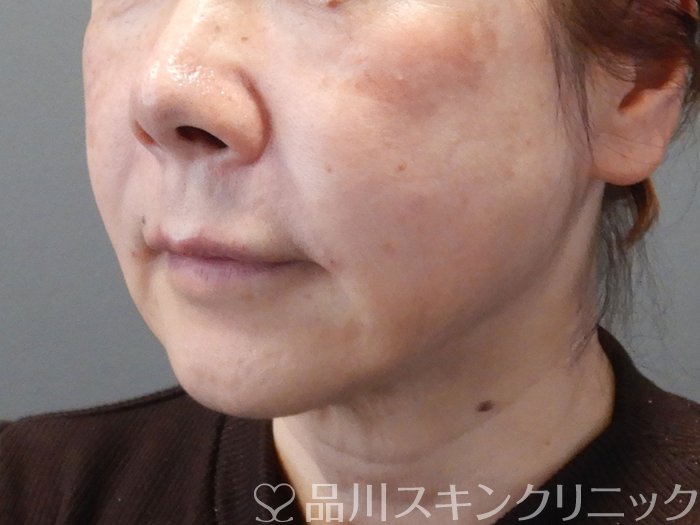 症例NO.73073のAFTER写真