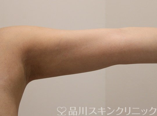 症例NO.72654のAFTER写真