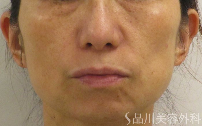 症例NO.65220のBEFORE写真