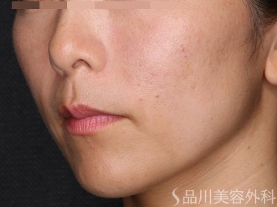 症例NO.72482のAFTER写真