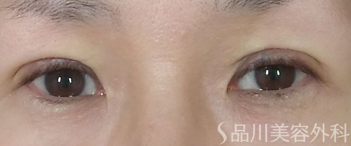 症例NO.67920のAFTER写真