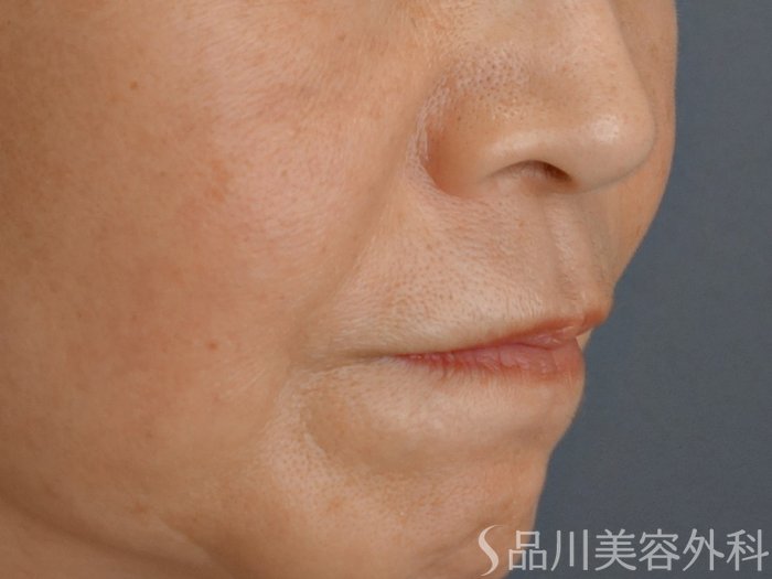 症例NO.72722のBEFORE写真