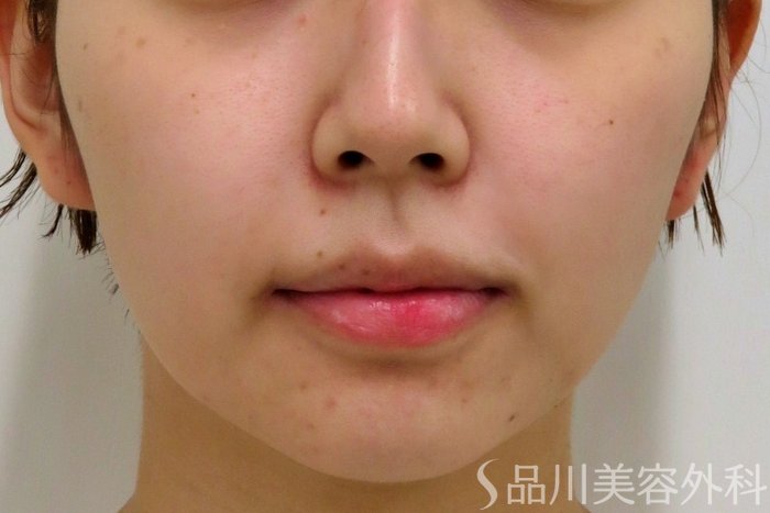 症例NO.74085のBEFORE写真