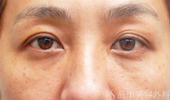 症例NO.52817のAFTER写真