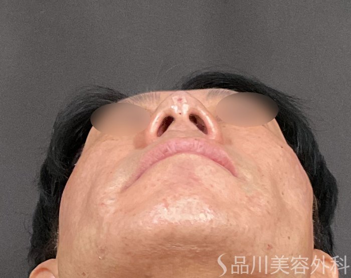 症例NO.74718のAFTER写真