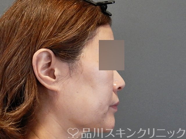 症例NO.66270のBEFORE写真