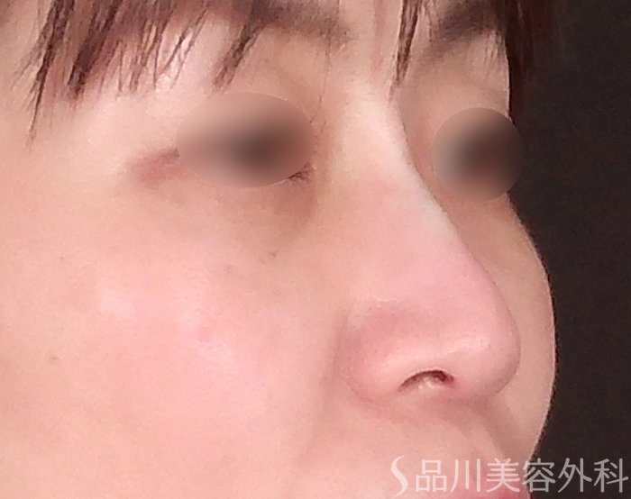 症例NO.69299のAFTER写真