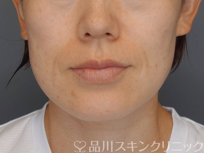 症例NO.71678のBEFORE写真