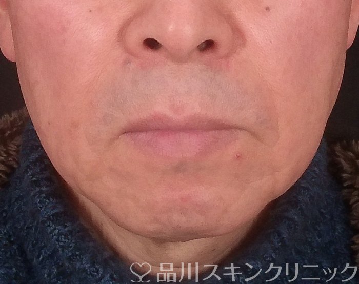 症例NO.69200のBEFORE写真