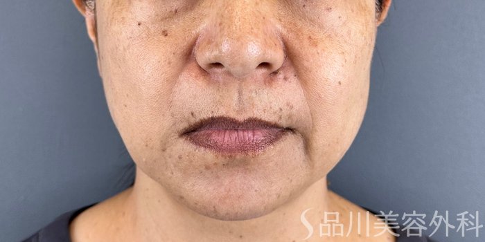 症例NO.71778のBEFORE写真