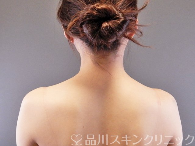 症例NO.64068のAFTER写真