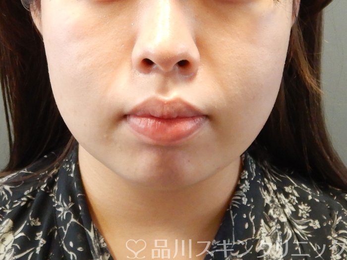 症例NO.62168のBEFORE写真