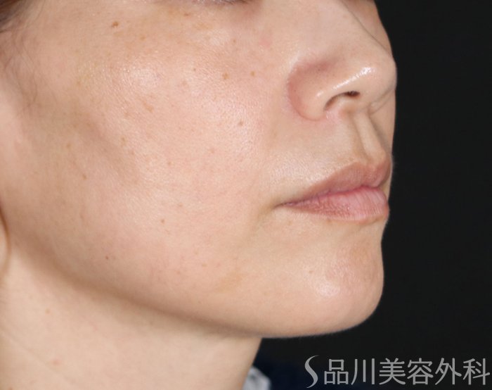 症例NO.72123のAFTER写真