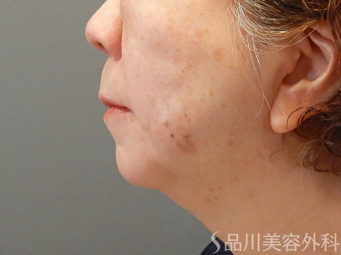 症例NO.70442のAFTER写真
