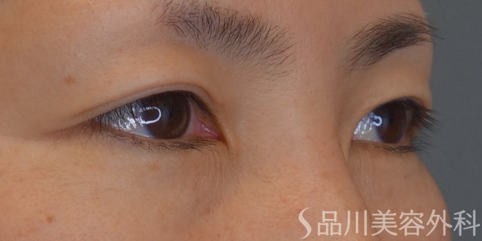 症例NO.68228のBEFORE写真