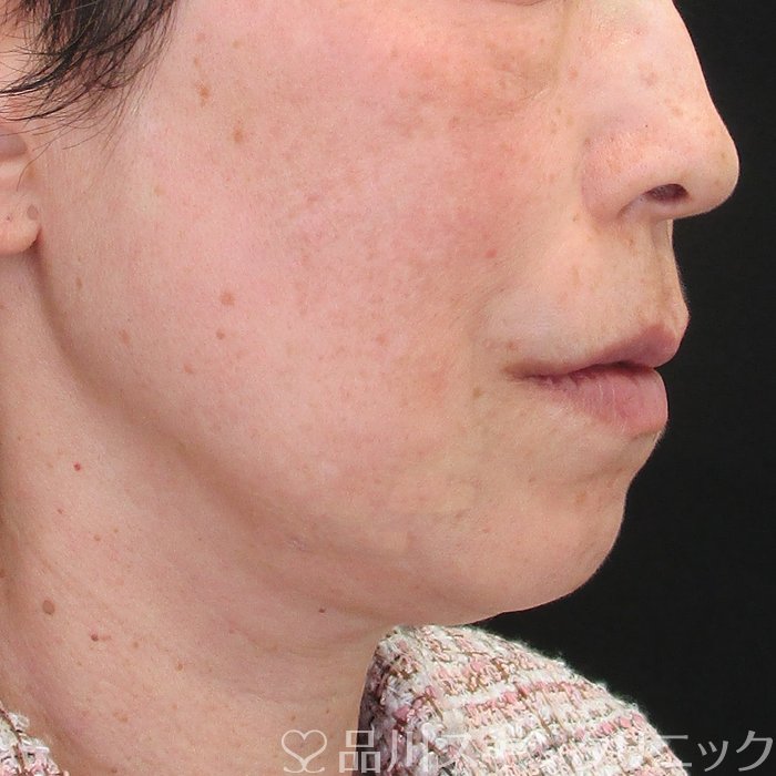 症例NO.73349のAFTER写真
