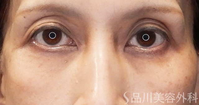 症例NO.67975のBEFORE写真