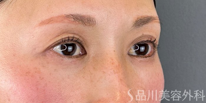 症例NO.70306のBEFORE写真