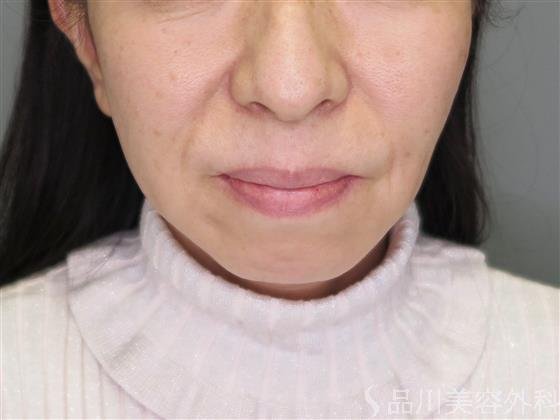 症例NO.49411のBEFORE写真