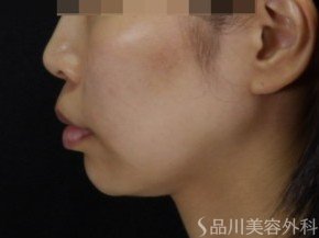 症例NO.71313のAFTER写真