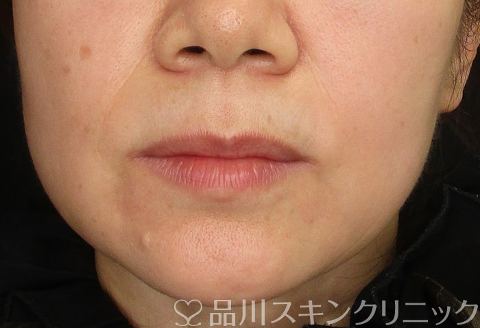 症例NO.70486のBEFORE写真