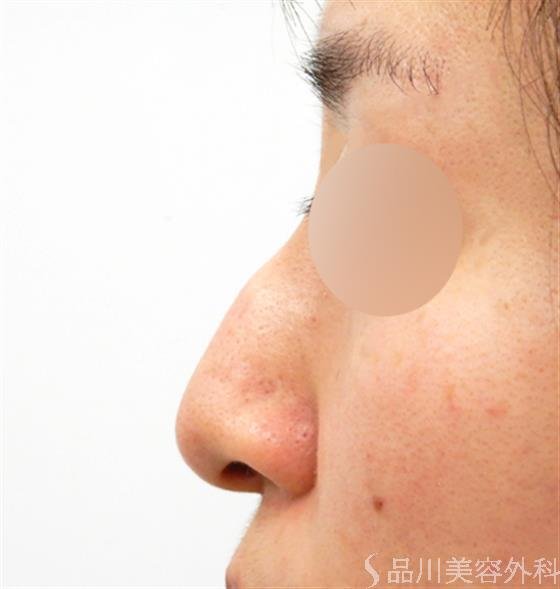 症例NO.53150のBEFORE写真